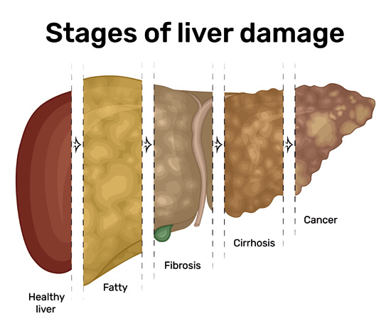 Stages of Liver Damage