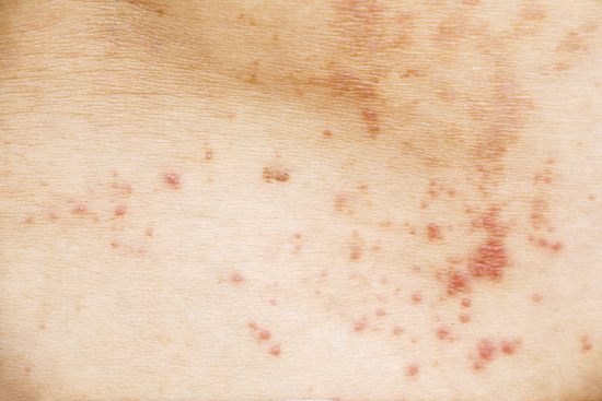 Heat Rash (Miliaria or Prickly Heat)