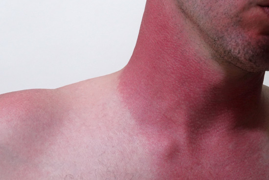 Sun Poisoning (Severe Sunburn)