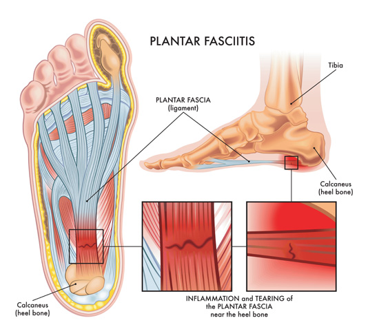 Plantar Heel Pain: Solutions for Pain Relief