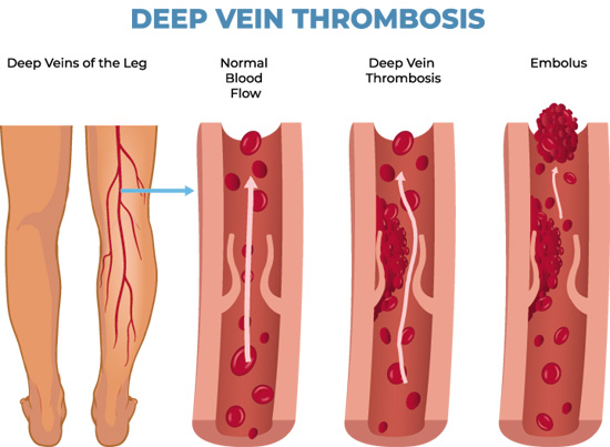 Deep Vein Thrombosis Illustration