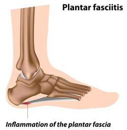Plantar Fasciitis