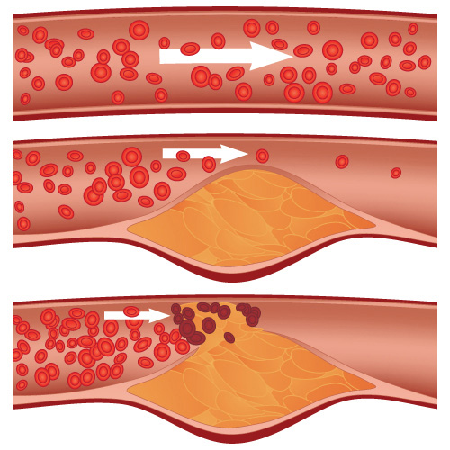 The top artery is healthy. The middle and bottom arteries show plaque formation, rupturing, clotting and blood flow interruption. 