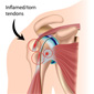 Rotator Cuff - Spotting Problems and Treatment Options