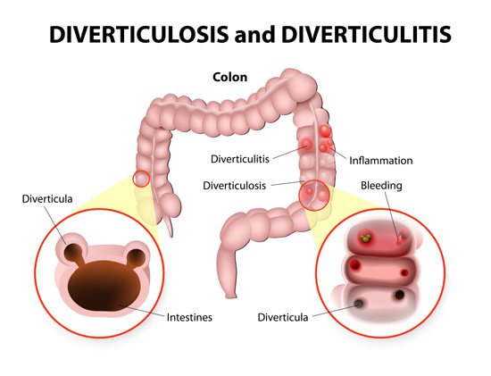 Diverticulitis